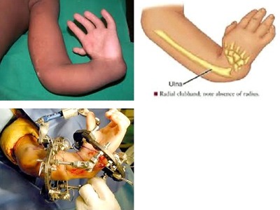 Desetiletému Josefovi pomůže s léčbou ruky unikátní aparát